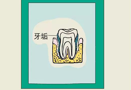 你真的了解牙周炎吗？